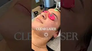 CLEAR LASER | SKIN CLINIC IN DUBAI #koreanskin #glowingskin #laser #clearskin #evenskin #brightskin