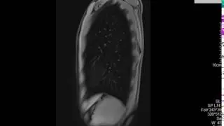 Mellkas MR felv&eacute;tel, Chest MRI