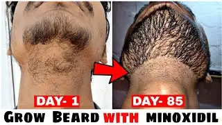 How to grow Beard with minoxidil in a month | minoxidil beard journey INDIA |  BEARD SECRET