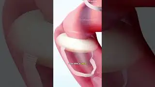 Ever wondered if a vaginal pessary ring could help improve comfort and daily life? #vulvovaginal