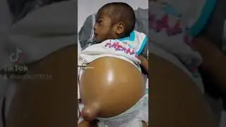 BILLIARY ATRESIA SURVIVOR (LiverDisease) #forevergrateful