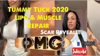 Tummy Tuck 2020 Lipo & Muscle Repair (Scar Reveal)