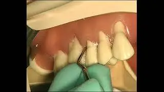 CURETTE GRACEY 13 14  - Manuale Online Per Igienista Dentale
