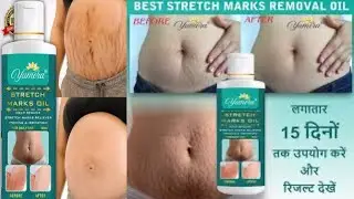 Does stretch mark oil work? Stretch marks oil review reddit | Honest Review 💫