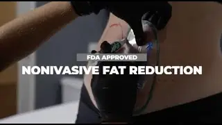 Coolsculpting Cosmetic Procedures for Fat Reduction and Skin Tightening | Vitalyc Medspa Dallas TX