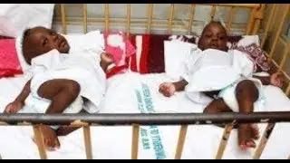 First conjoined twins separation: Minister commends National Hospital