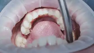 Why it is important to do a Tooth Replacement after Tooth Extraction | Dr Calvin Isaac Daniel