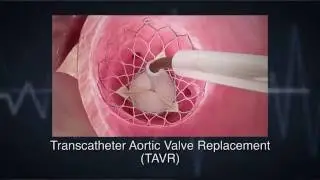 Count on PinnacleHealth for Advances in Cardiovascular Medicine
