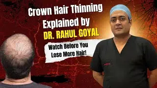 Crown Area Hair Thinning Treatment | Dr. Rahul Goyal | Best Hair Transplant in Srinagar