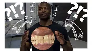 EXTREME SMILE MAKEOVER!! 😱🦷 FULL MOUTH DENTAL CROWNS IN MEXICO [XDentistry Tijuana Reviews]