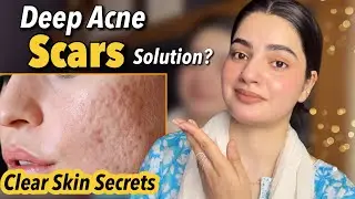 Deep Acne Scars? Try This Powerful Home Treatment (FAST Results) 