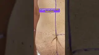Tummy Tucks: Dr. Manny's Expert Insight