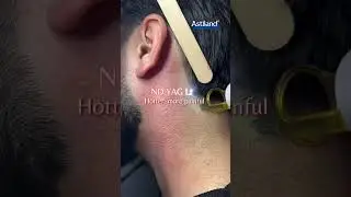 Diode Laser vs ND YAG Laser, which one you prefer?