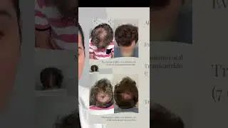 Alcanza un cabello perfecto con la medicaci&oacute;n ideal: Dutaster&iacute;a y minoxidil oral