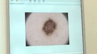Hautkrebsvorsorge - Computergest&uuml;tzte Videodokumentation
