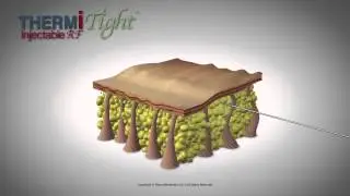 ThermiTight