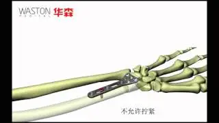 Distal Medial Radius LOC Plate (Adjustable) Waston Medical