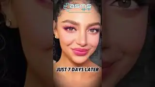 ✨ Facial Rejuvenation for a 44 Year Old ✨Descrip