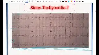 ECG Part 4 : كيف نقرأ الرسم (٢)