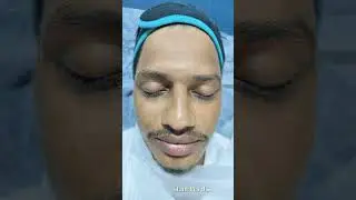 Helios III : Q-Switched Nd Yag Laser Treatment LASEROPTEK