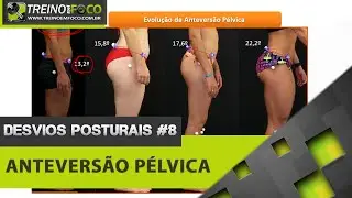 Anteversão Pélvica - Equilíbrio Pélvico - Desvios Posturais #8