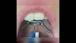 How to turn an expander