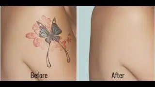 Permanent Tatoo Removal through Laser | Dr Priyanka Yadav Best Dermatologist Gurgaon
