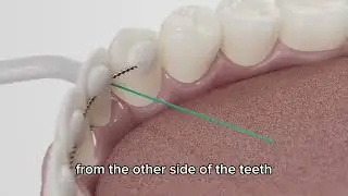 How to Floss Bonded Teeth & Fixed Retainers (Easy Method with The AutoFlosser)