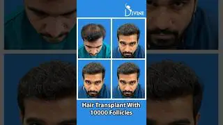 Get the Best Hair Transplant Result with No Visible Scars at Divine | Hair Transplant Delhi #short