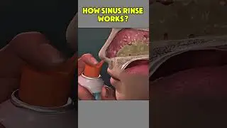 How sinus rinse works?#sinus#Rinse#Working#medicalworld #shorts