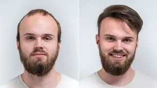 Amazing hair replacement at 18  | Transformation with Hairsystem | Hairsystems Heydecke