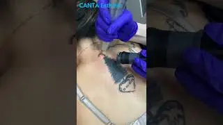 Witness the magic of our laser tattoo removal machines!😍