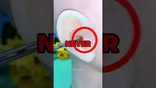 Never Use Cotton Swabs!