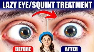 Lazy Eye or Squint Treatment | How to Treat Lazy Eye?