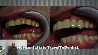 Impianti dentali in Moldavia: la storia di Adriano tra errore e rinascita