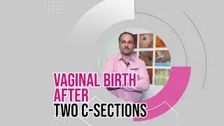 Vaginal birth after two cesarean sections