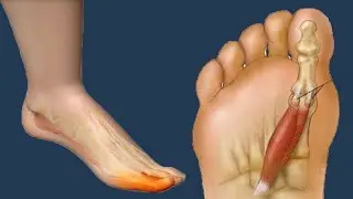 Toe Cramps: Causes And Prevention