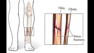 stress fractures in athletes; tiny cracks in bones caused by repetitive mechanical stress