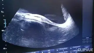 congenital urethral dilatation