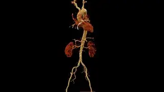9 mL total contrast CTA of the aorta using spectral CT (40 keV virtual monoenergetic imaging)