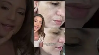 Halo Laser for the win! #Halo #halolaser #skinrejuvenation
