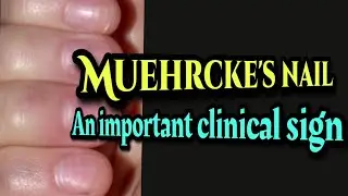 Muerhcke's nail || White bands in nails