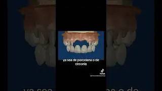 🟢 #tipsdentales Puente dental de 6 unidades para sustituir dientes faltantes 😀❤️