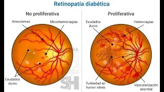 Retinopat&iacute;a diab&eacute;tica y Estrabismo - actualizado