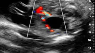 OB Umb Art Bladder Color | Clinical Image