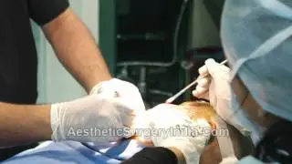 FUE Hair Transplant, Chandigarh, India