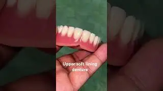 Upper soft lining denture 😬😬😬#apexdental #dentistry #partialdenture #orthodontist #splittooth