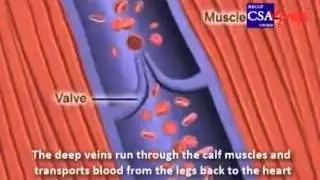 CSA Case   explaining DVT in your MRCGP exam csaprep   CSA course + cases