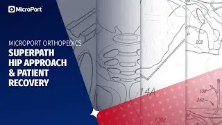SuperPath Hip Approach & Patient Recovery