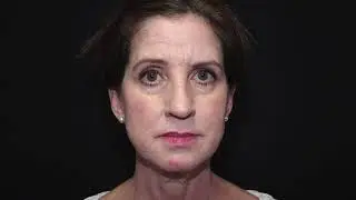 CO2 Laser Treatment | Before & After